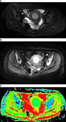 The Preeminent Value of the Apparent Diffusion Coefficient in Assessing High-Risk Factors and Prognosis for Stage I Endometrial Carcinoma Patients